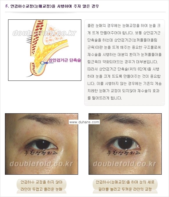[두한성형외과 경쟁력 쌍꺼풀 재수술, 극한 눈재수술] - [쌍꺼풀 재수술, 눈 재수술의 실패 원인] 관련 이미지 5