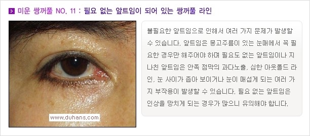 [두한성형외과 경쟁력 쌍꺼풀 재수술, 극한 눈재수술] - [자연스러운 눈매로의 복원 쌍꺼풀 재수술 대상 안내] 관련 이미지 12