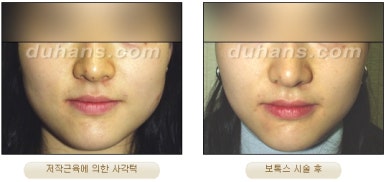 [Duhan Plastic Surgery Clinic Aesthetic Procedures] - [Square Jaw Botox] image 4