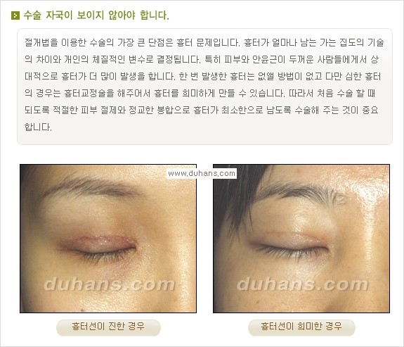 [두한성형외과 경쟁력 눈성형] - [눈성형, 쌍꺼풀 수술 방법에 관한 자주하는 질문과 답변 안내] 관련 이미지 3