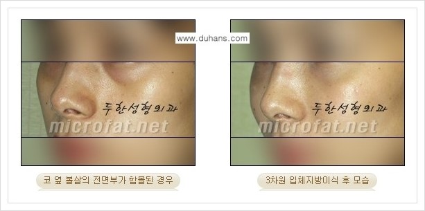 [두한성형외과 경쟁력 미세지방이식] - [귀족수술과 인디언밴드(앞광대주름) 미세지방이식] 관련 이미지 14