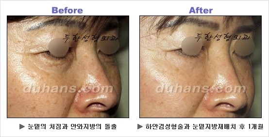 [두한성형외과 경쟁력 동안성형 리더] - ​[미간주름, 이마주름, 안검성형, 이마거상술, 눈썹거상술] 관련 이미지 91