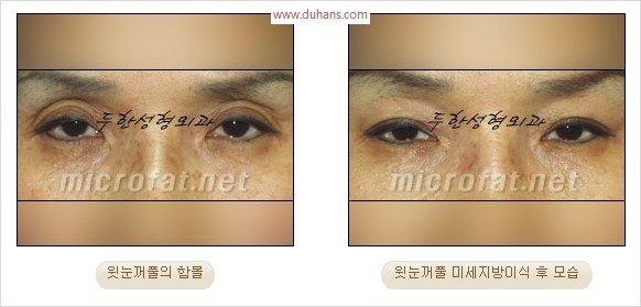 [두한성형외과 경쟁력 눈성형 리더] - [윗눈꺼풀 함몰( #꺼진눈꺼풀) 미세지방이식과 상안검성형]#꺼진눈성형 , #눈위함몰 관련 이미지 13