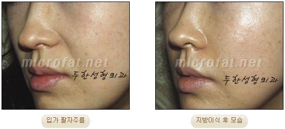 Wrinkle Improvement, Duhan Plastic Surgery - Mouth Lines, Nasolabial Folds image 10