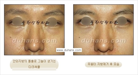 [두한성형외과 젊은 눈매 안검성형] - [눈밑 지방제거의 수술 전후 안내 ①] 관련 이미지 5
