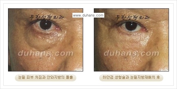 [두한성형외과 경쟁력 눈성형] - [젊은 눈매로의 복원 안검성형] 관련 이미지 24