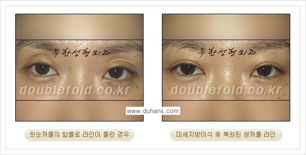 [두한성형외과 경쟁력 쌍꺼풀 재수술, 극한 재수술] - [미세지방이식으로 풀린 쌍꺼풀 교정] 관련 이미지 6