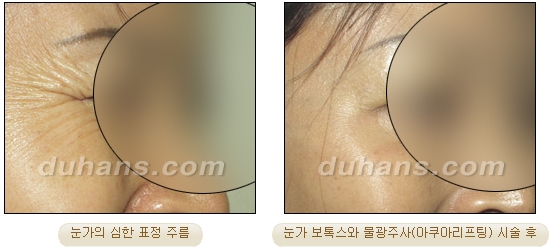 [두한성형외과 주름개선] - [주름교정 방법] 관련 이미지 20