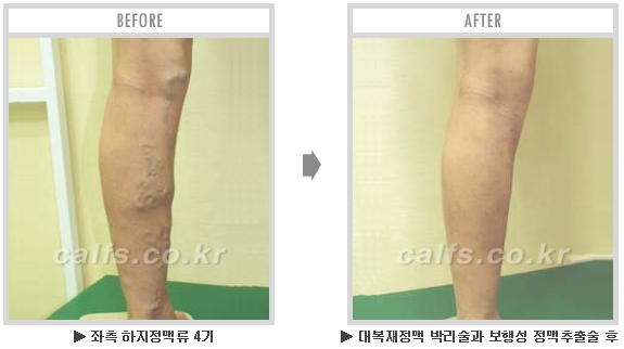 [종아리성형 두한성형외과] - [종아리수술에 대한 자주하는 질문과 답변 모음] 관련 이미지 12