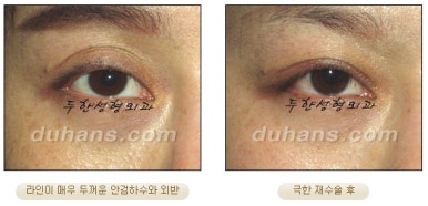 [Special Double Eyelid Revision Surgery at Duhan Plastic Surgery] - [Restorative Surgery for Damaged Double Eyelid Eye Shape] image 27