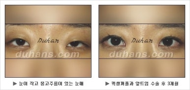 Best Place for Double Eyelid Revision Surgery, Duhan Plastic Surgery - Partial Incision Eye Revision Surgery image 14
