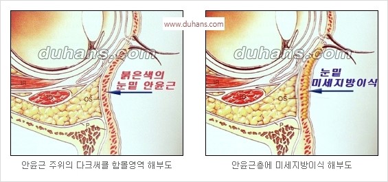 [두한성형외과 경쟁력 안검성형] - [젊은 눈매 안검성형의 여러 가지 방법 안내] 관련 이미지 67