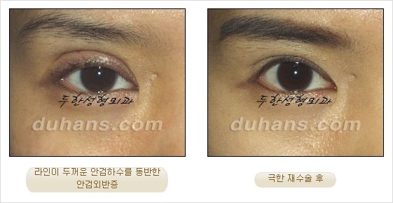 [두한성형외과 경쟁력 쌍꺼풀 재수술 리더 ] - [쌍꺼풀 재수술 과정, 쌍꺼풀 재수술 실패의 원인, 극한 재수술] 관련 이미지 18