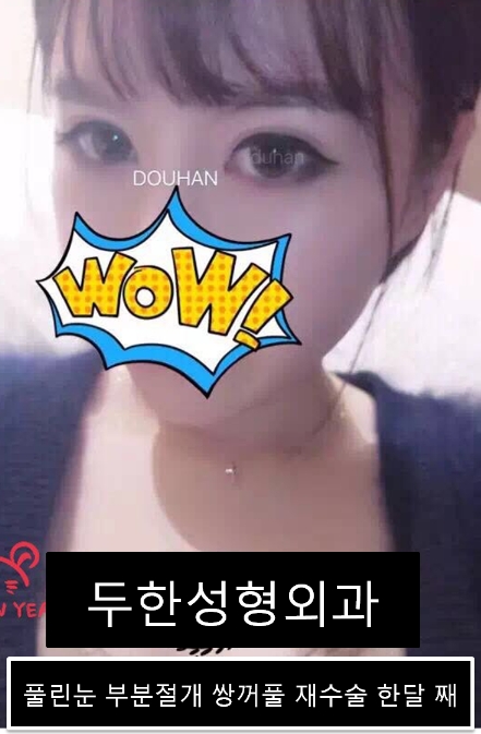 [Duhan Plastic Surgery] - [Revision Surgery for Relaxed Double Eyelids] image 3