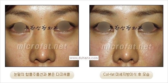 [두한성형외과 경쟁력 눈밑성형] - [눈밑이 전반적으로 함몰된 다크써클 교정 안내] 관련 이미지 10