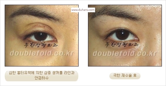 [두한성형외과 경쟁력 쌍꺼풀 재수술 스페셜] - [망가진 라인을 교정하는 극한 재수술] 관련 이미지 8