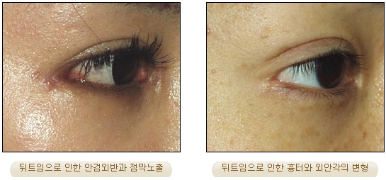 [Duhan Plastic Surgery Double Eyelid Revision] - [Inner Corner Revision, Outer Corner Revision] image 12