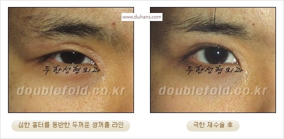 [두한성형외과 경쟁력 쌍꺼풀 재수술 스페셜] - [망가진 라인을 교정하는 극한 재수술] 관련 이미지 18