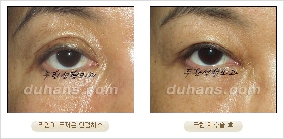 [두한성형외과 경쟁력 쌍꺼풀 재수술 리더 ] - [쌍꺼풀 재수술 과정, 쌍꺼풀 재수술 실패의 원인, 극한 재수술] 관련 이미지 9