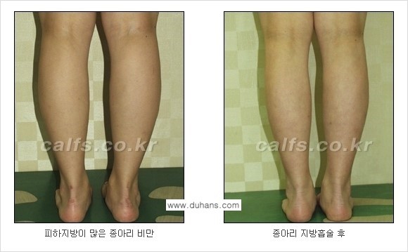 [두한성형외과 경쟁력 종아리성형] - [종아리 지방흡입 2.] 관련 이미지 10