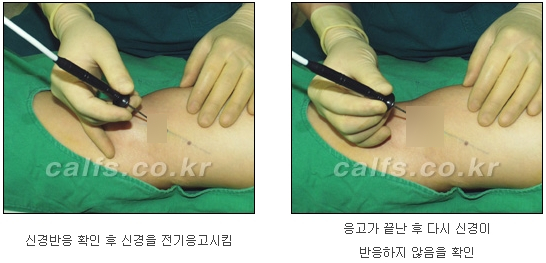 [종아리알제거 두한성형외과] - [초음파유도선택적신경차단술] 관련 이미지 11