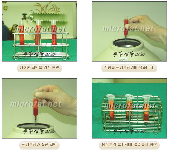 Fat Grafting Leader Duhan Plastic Surgery - Everything About Fat Grafting image 59