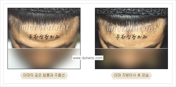 [두한성형외과 경쟁력 미세지방이식] - [부드럽고 아름다운 얼굴 윤곽선 이마(전두부) 미세지방이식] 관련 이미지 11