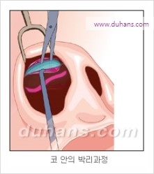 [두한성형외과 경쟁력 코성형 리더] - [자연스럽고 오똑한 콧망울! 코성형 방법]​ 관련 이미지 4