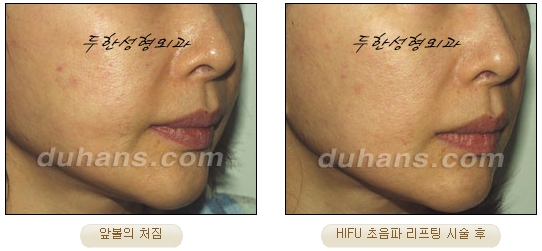 [Duhan Plastic Surgery Lift] - [Double Chin, Drooping Cheeks, Sagging Neck Skin, Wrinkle Improvement] image 14
