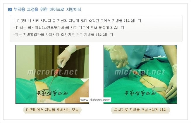 [두한성형외과 경쟁력 미세지방이식] - [타병원에서의 미세지방이식 부작용 교정 방법 안내] 관련 이미지 7