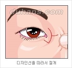 쌍커풀수술 두한성형외과 - 나에게 맞는 눈성형은? 관련 이미지 55