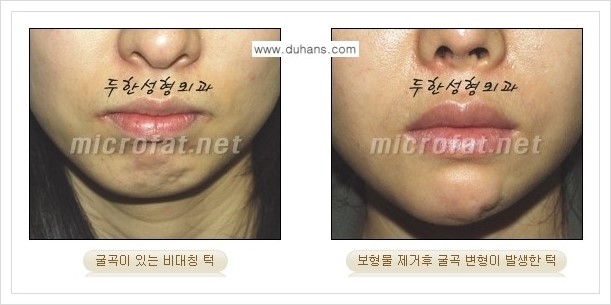 [두한성형외과의 경쟁력 미세지방이식] - [무턱교정, 턱 미세지방이식 안내 1.] 관련 이미지 2