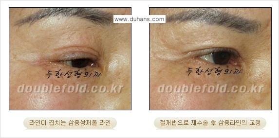 ​[두한성형외과 경쟁력 극한 눈(쌍꺼풀) 재수술] - [삼중 쌍꺼풀 라인의 교정] 관련 이미지 9