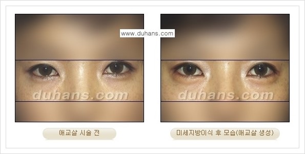 [두한성형외과 경쟁력 눈밑성형] - [눈밑 애교살 시술을 위한 미세지방이식 안내] 관련 이미지 5