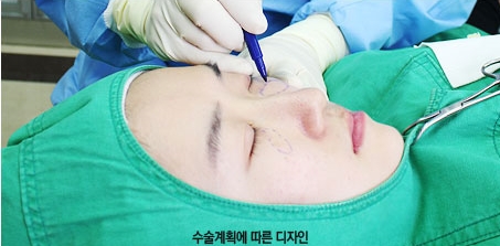 [두한성형외과 다크서클] - [다크서클 콜펫지방이식] 관련 이미지 6