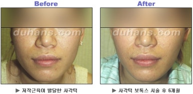 [Duhan Plastic Surgery Clinic Aesthetic Procedures] - [Square Jaw Botox] image 25