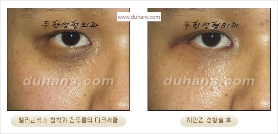[두한성형외과 경쟁력 안검성형] - [눈밑주름 제거수술] 관련 이미지 20