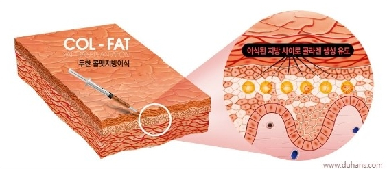 [두한성형외과 다크서클] - [콜펫지방이식] 관련 이미지 4