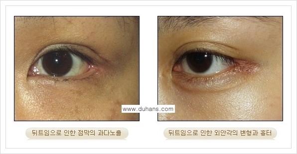 [두한성형외과 경쟁력 있는 쌍꺼풀 재수술] - [뒤트임 수술] 관련 이미지 3
