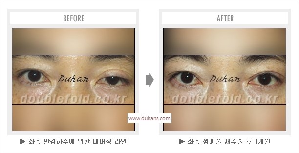 [두한성형외과 경쟁력 눈성형] - [나에게 맞는 어울리는 쌍꺼풀 라인] 관련 이미지 49