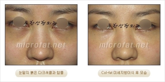 [두한성형외과 경쟁력 눈밑성형] - [Dr. 컬럼 - 눈밑 다크써클의 치료 방법과 치료 효과] 관련 이미지 2