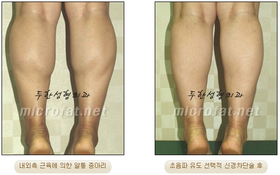 [Duhan Plastic Surgery Clinic Calf Contouring] - [Calf Reduction] image 22