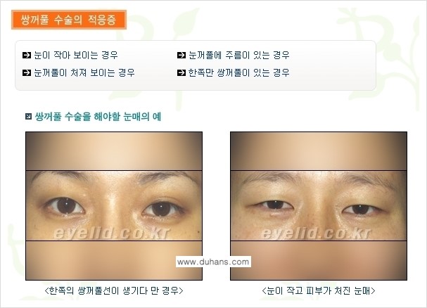 [두한성형외과 경쟁력 눈성형] - [퀵쌍꺼풀(부분절개법) 수술 안내] 관련 이미지 7