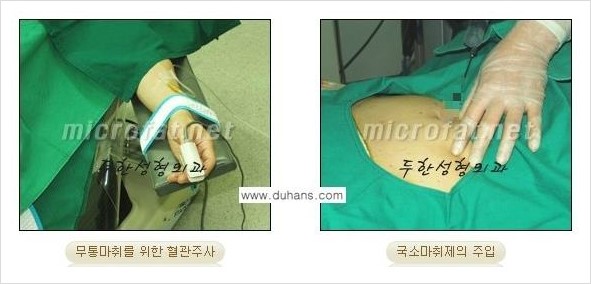[두한성형외과 경쟁력 바디성형] - [하복부, 팔뚝, 허리선, 허벅지, 엉덩이 간편지방흡입술] 관련 이미지 7