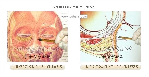 [두한성형외과 경쟁력 눈밑성형] - [눈밑 다크써클, 눈밑 주름의 교정 안내 1.] 관련 이미지 13