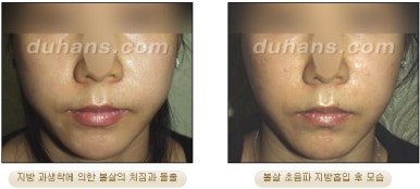 [두한성형외과 안전한 지방흡입] - [얼굴지방흡입] 관련 이미지 32
