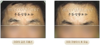 이마성형 두한성형외과 - 이마주름, 이마지방이식 관련 이미지 11