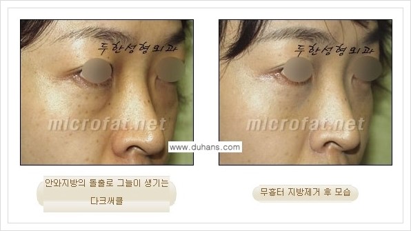 [두한성형외과 경쟁력 눈밑성형] - [눈밑지방제거, 눈위지방제거 안내 1.] 관련 이미지 12