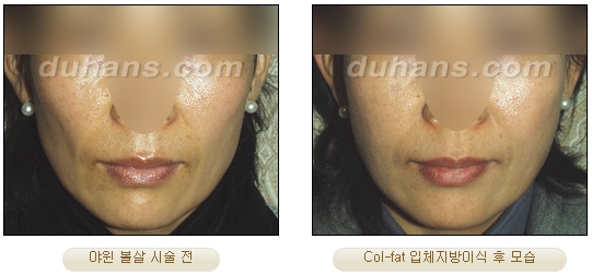 [Duhan Plastic Surgery Facial Autologous Fat Grafting] - [Fat Grafting Guide] image 33