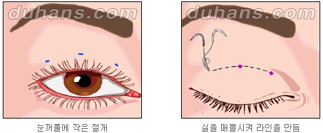 [Duhan Plastic Surgery Double Eyelid Surgery] - [Double Eyelid Guide] image 4